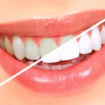 Dental-Bleaching