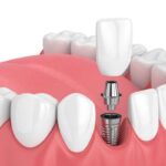 Dental Implant