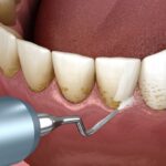 Dental Scaling