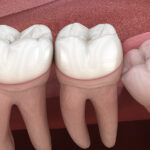 Impacted-Teeth