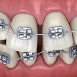 Orthodontic