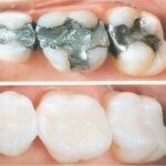 composite