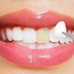 dental-veneers